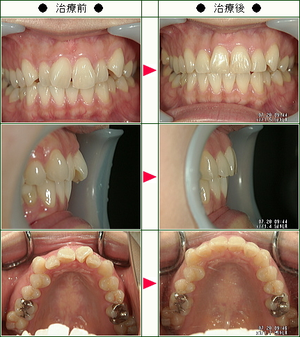 歯のデコボコ矯正症例(Ｓ.Ｔ.様　３１歳　女性)