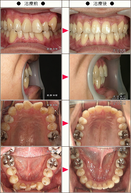 歯のデコボコ矯正症例［Ｓ・Ｔ様　３６歳　男性］