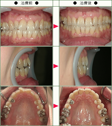 歯のデコボコ矯正症例(Ｓ.Ｔ様　４１歳　女性)