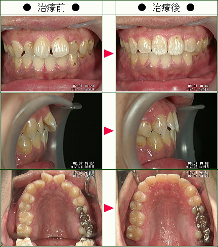 歯のデコボコ矯正症例(須藤様　３１歳　男性)