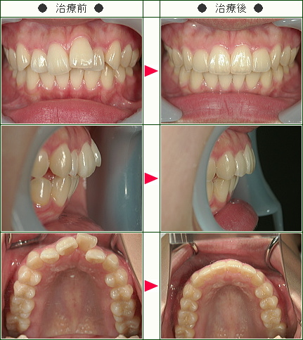 歯のデコボコ矯正症例(菅野様　１９歳　女性)