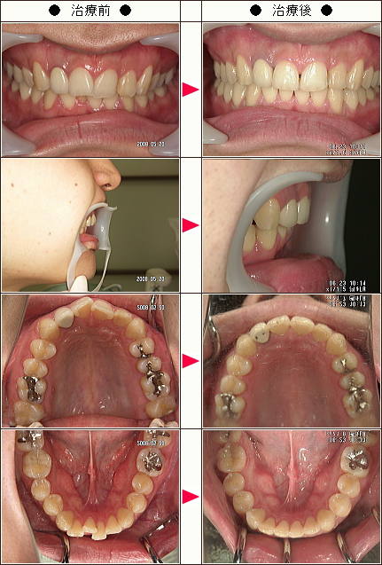 歯のデコボコ矯正症例［スギタ様　２５歳　男性］