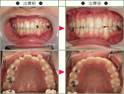 歯のデコボコ矯正症例(スギウラ様　２６歳　女性)