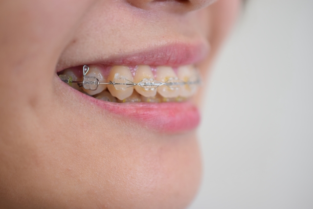 差し歯がある人の矯正治療の特徴