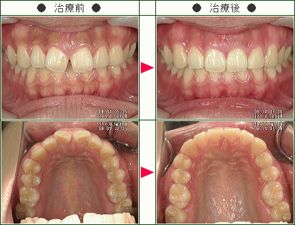 前歯のすきっ歯矯正症例(鈴木様　２０歳　女性)