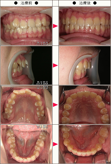 出っ歯矯正症例［鈴木様　２１歳　女性］