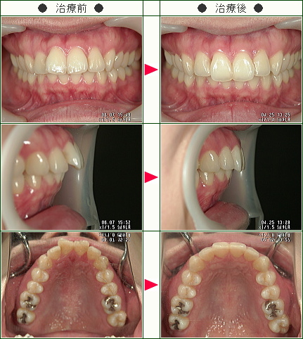 出っ歯矯正症例(鈴木様　２４歳　女性)