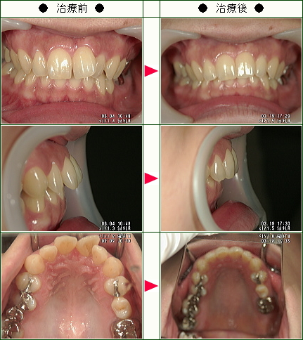 歯のデコボコ矯正症例(鈴木様　３１歳　女性)
