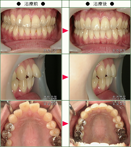 出っ歯矯正症例(鈴木様　３２歳　女性)
