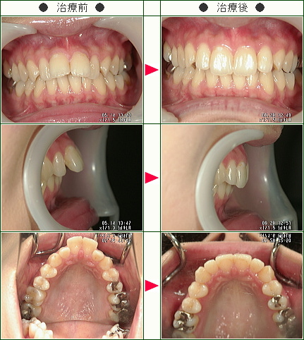 出っ歯矯正症例(Ｓ・Ｙ様　２６歳　女性)