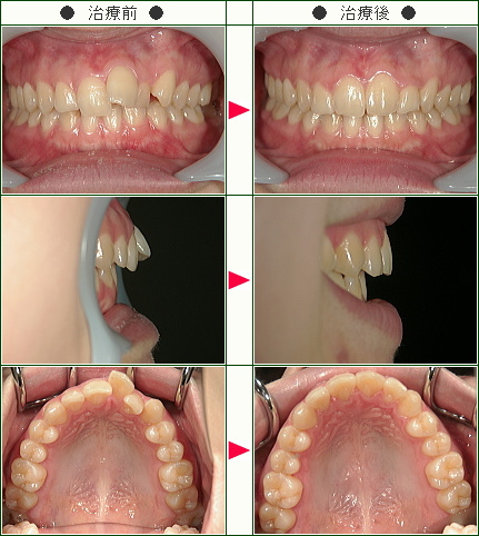 歯のデコボコ矯正症例(Ｓ.Ｙ様　２９歳　女性)