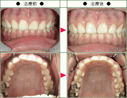 歯のデコボコ矯正症例(Ｓ．Ｙ様　２９歳　女性)
