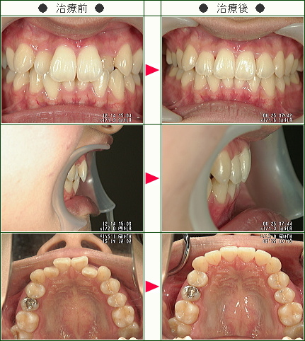 歯のデコボコ矯正症例(Ｔ様　２２歳　女性)