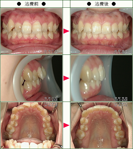 歯のデコボコ矯正症例(Ｔ様　２７歳　女性)