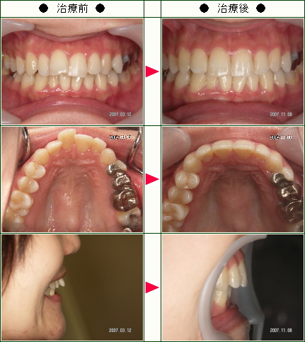 歯のデコボコ矯正症例(Ｔ様　３１歳　女性)