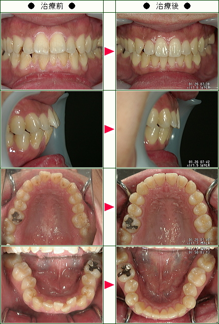 歯のデコボコ矯正症例(Ｔ様　３２歳　男性)