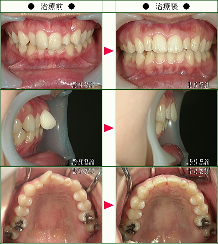 歯のデコボコ矯正症例(Ｔ・Ａ様　２５歳　女性)