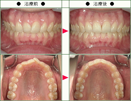 歯のデコボコ矯正症例(Ｔ.Ａ様　２７歳　女性)