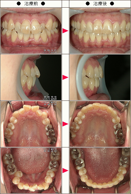 歯のデコボコ矯正症例［Ｔ．Ａ様　女性］