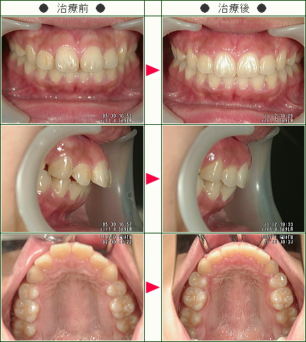 出っ歯矯正症例(田原様　１９歳　女性)