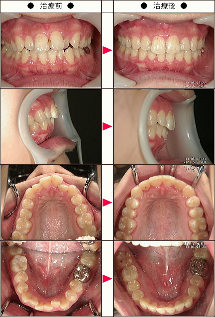 歯のデコボコ矯正症例［高橋様　２０歳　女性］