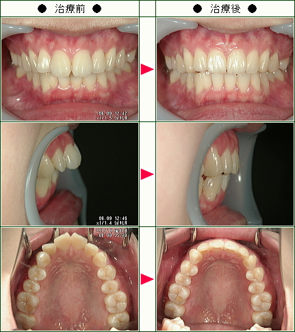 出っ歯矯正症例(タカハシ様　２１歳　女性)