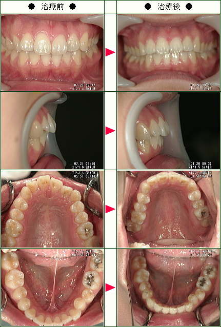 出っ歯矯正症例(たかはし様　２５歳　女性)