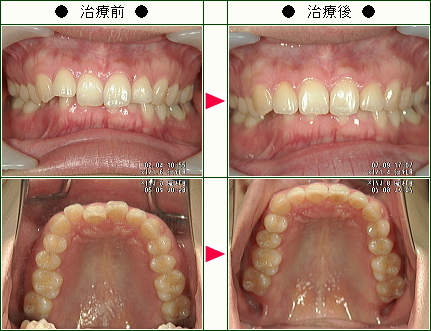 歯のデコボコ矯正症例(高橋様　３４歳　女性)