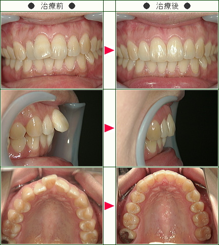 出っ歯矯正症例(高井様　３１歳　女性)