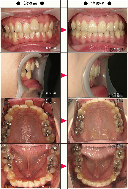歯のデコボコ矯正症例［高子様　３０歳　女性］