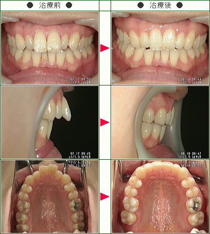 出っ歯矯正症例(たかみ様　２７歳　女性)