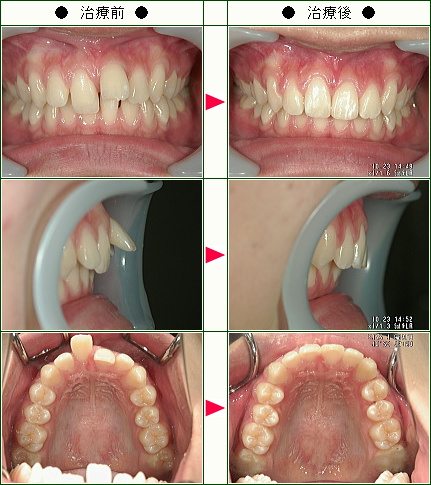 出っ歯矯正症例(武田様　１９歳　女性)