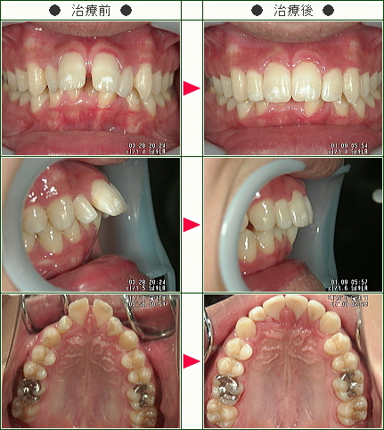 出っ歯矯正症例(竹村様　１９歳　男性)