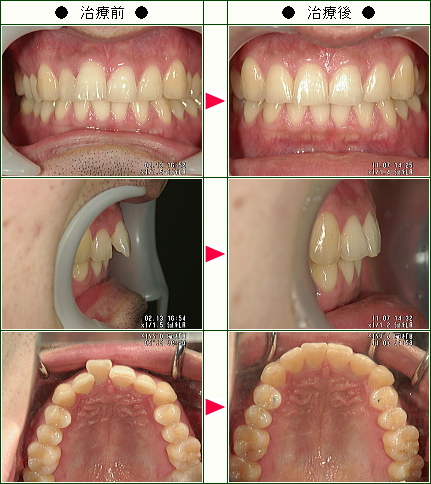 歯のデコボコ矯正症例(竹内様　２６歳　男性)