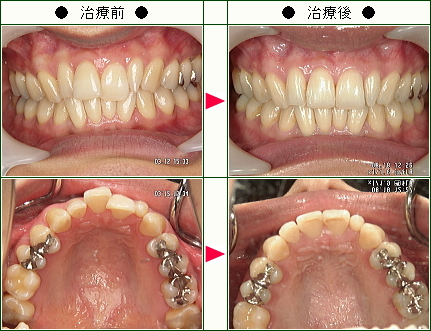 歯のデコボコ矯正症例(竹内様　３１歳　女性)