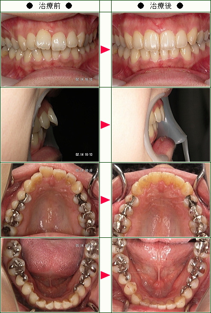 歯のデコボコ矯正症例(たま様　３０歳　女性)