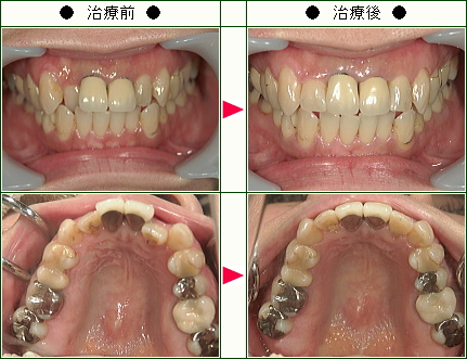 歯のデコボコ矯正症例(田中様　３８歳　女性)