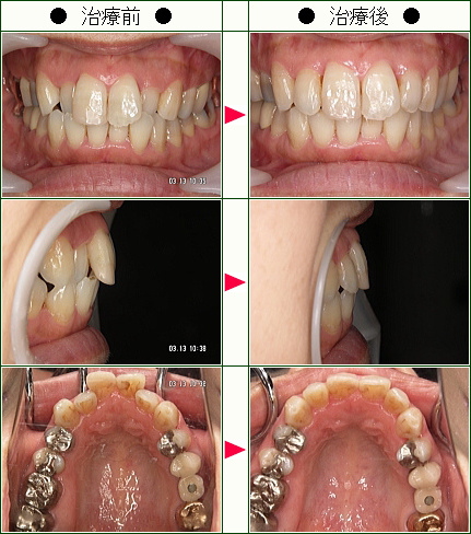 歯のデコボコ矯正症例(田中様　４５歳　女性)