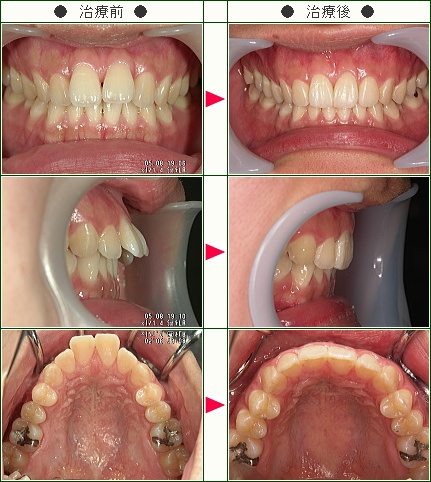 出っ歯矯正症例(Ｔ・Ｅ様　２８歳　女性)