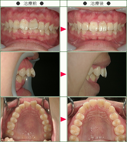 出っ歯矯正症例(手塚様　１８歳　女性)