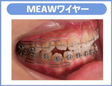 • MEAWワイヤーを使用した歯を抜かない全体矯正:約1年。