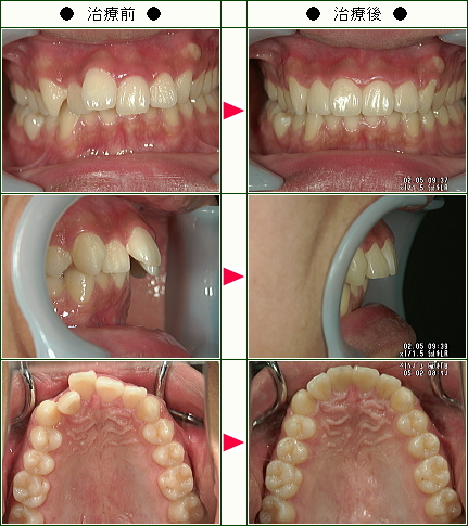歯のデコボコ矯正症例(Ｔ.Ｈ様　１９歳　男性)