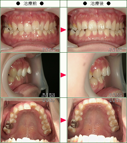 歯のデコボコ矯正症例(Ｔ．Ｉ様　２６歳　女性)