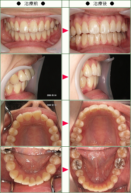 出っ歯矯正症例(Ｔ・Ｋ様　２３歳　女性)