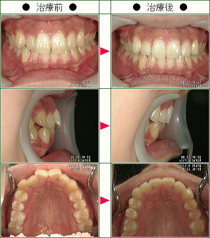 歯のデコボコ矯正症例(Ｔ．Ｋ様　２４歳　女性)