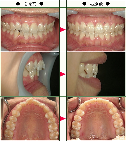 歯のデコボコ矯正症例(ＴＫ様　２６歳　女性)