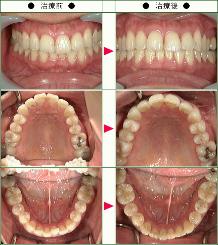 歯のデコボコ矯正症例(Ｔ.Ｋ様　３０歳　女性)