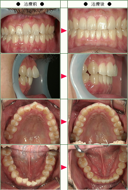 歯のデコボコ矯正症例(Ｔ.Ｋ様　３２歳　男性)