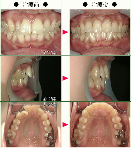歯のデコボコ矯正症例(Ｔ．Ｋ様　３４歳　女性)