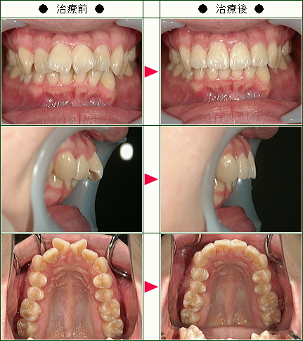 歯のデコボコ矯正症例(Ｔ・Ｍ様　２７歳　女性)